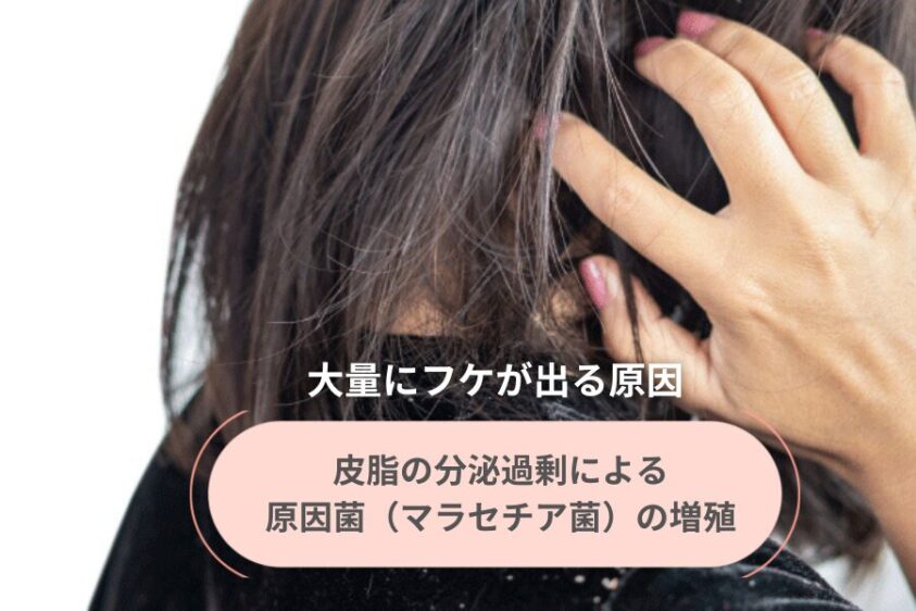 湯シャンで大量にフケが出る原因