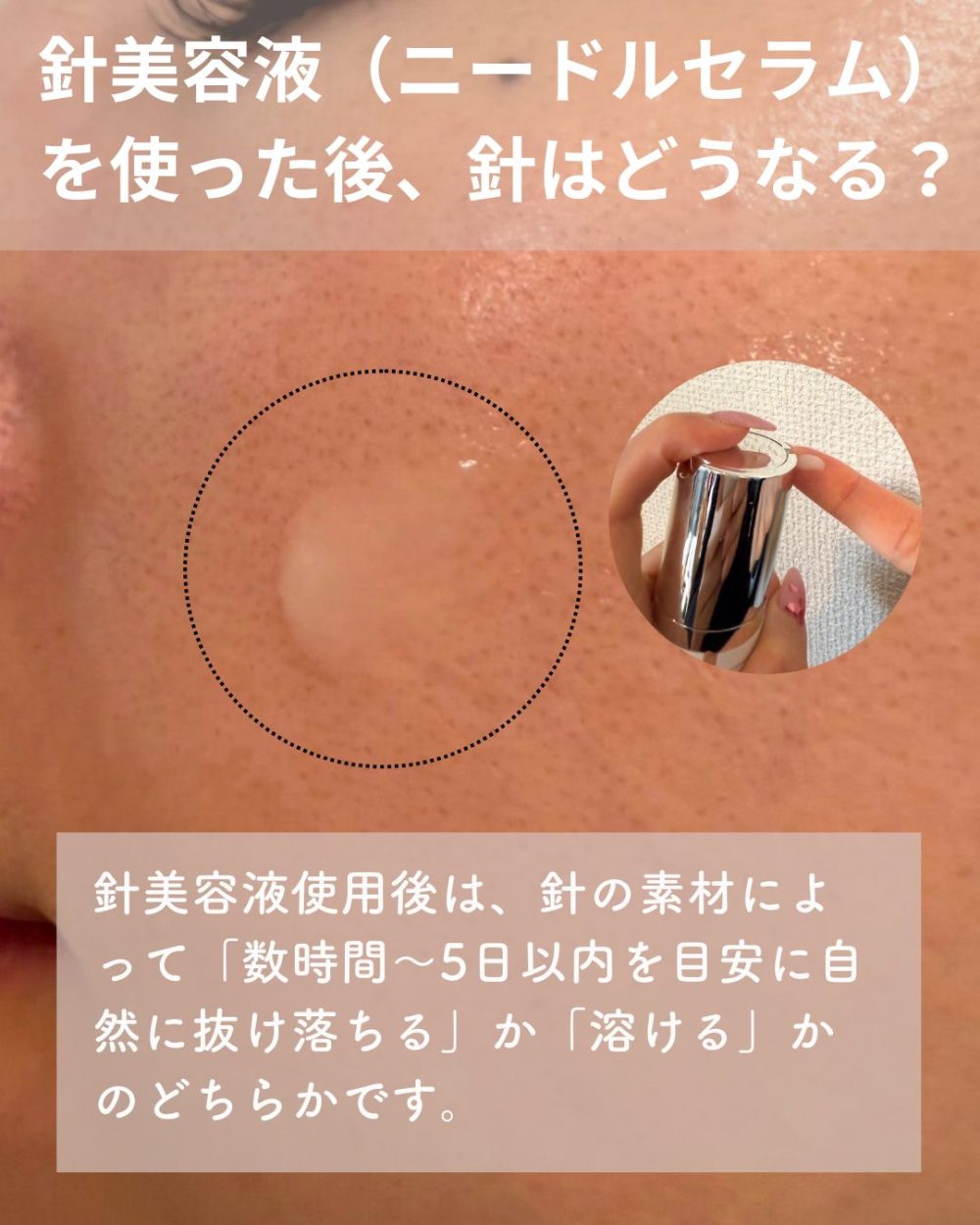 針美容液を使った後、針はどうなる